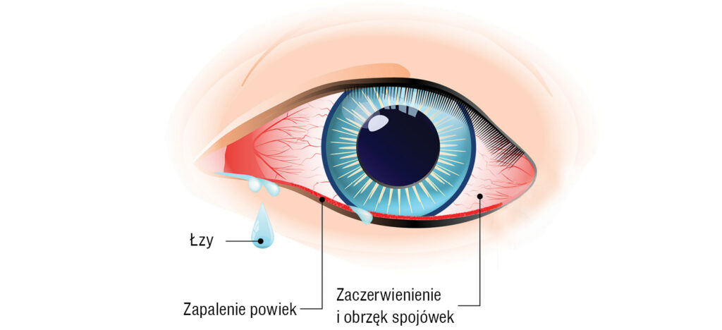 Rysunek poglądowy miejsca zapalenia oka
